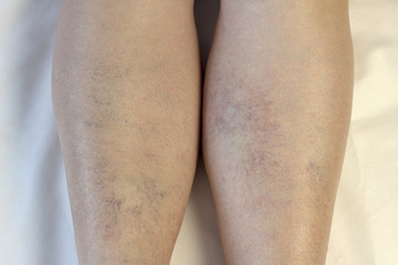 Varicose veins on legs, white background