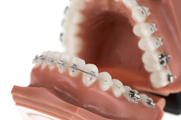 Orthodontic braces on a white background