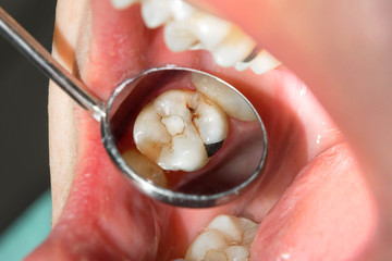 close-up of a human rotten carious tooth at the treatment stage in a dental clinic