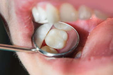 close-up of a human rotten carious tooth at the treatment stage in a dental clinic