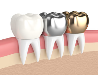 3d render of teeth with different types of dental crown