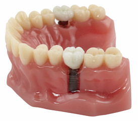 Close up of a Dental implant model.
