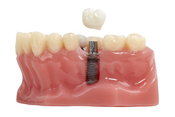 Close up of a Dental implant model.