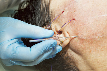 Dermatologist performs lines lifting face, a anti-age procedure using PDO wire on middle-aged woman patient - selective focus