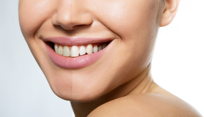 Obraz premium Zęby przed i po pielęgnacji, terapii i wybielaniu. Śmiejąc się usta kobiety wielkie zęby na białym tle. Zdrowy piękny uśmiech kobiet.