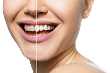 Teeth before and after care, therapy and whitening. Laughing woman mouth with great teeth over white background. Healthy beautiful female smile.