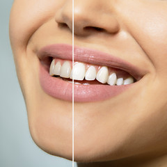 Teeth before and after care, therapy and whitening. Laughing woman mouth with great teeth over white background. Healthy beautiful female smile.