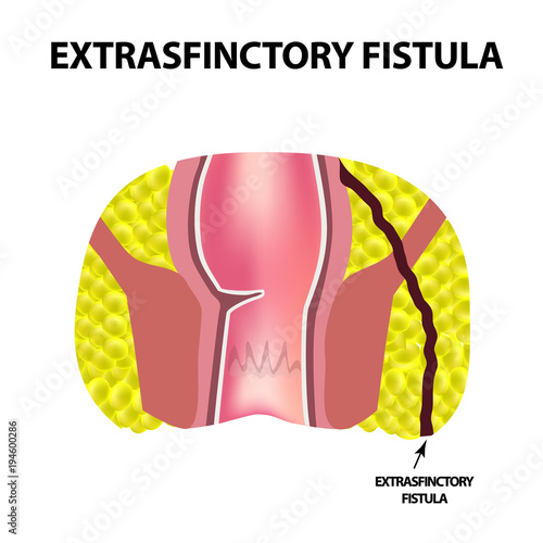 "Types of fistulas of the rectum. Paraproctitis. Anus. Abscess of the rectum. Infographics