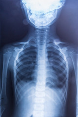 x-ray picture of baby chest, arms, stomach