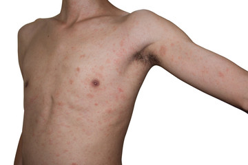 man show his rash body, allergies symptom, skinny man suffering from virus infected on white...