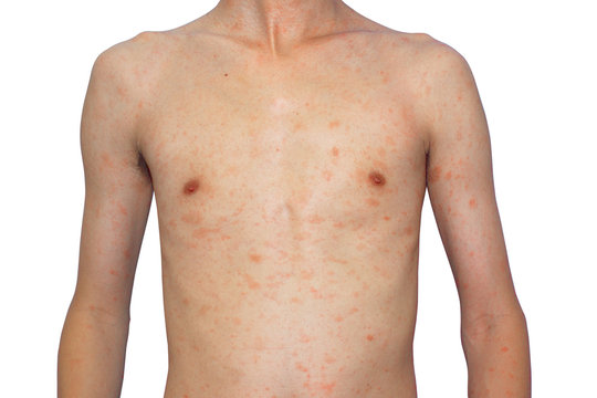 rash on skinny body, man suffering from virus, allergies skin, front view of a man with skin rash on white background, isolate with clipping path