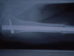 Röntgenbild mit Knochennagel 