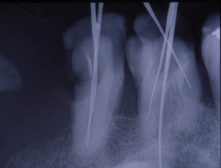 Röntgenbild von Zähnen