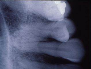 Röntgenbild von Zähnen