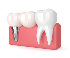 3d render of implant with dental cantilever bridge
