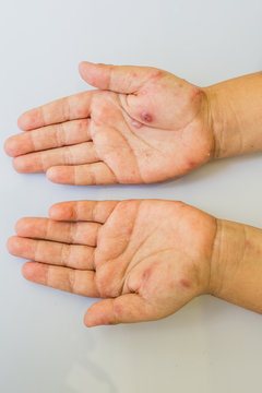 chicken pox hand.
