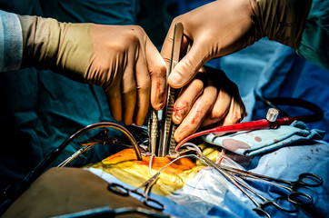 The process of performing a heart surgery using the apparatus of artificial arterial circulation.
