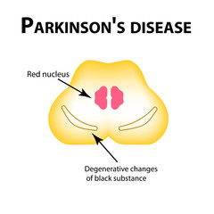 Parkinson's disease. Degenerative changes in the brain are a black substance. Vector illustration on isolated background.