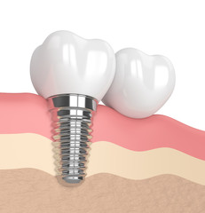 3d render of implant with dental cantilever bridge