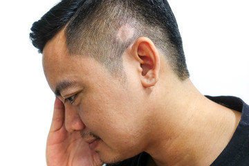 Obraz premium Asian men have stress when hair loss is a ring.