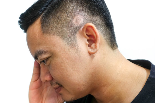 Asian men have stress when hair loss is a ring.