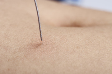Close up Hand Perform Medical of professional acupuncture treatment