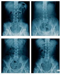 colletion spine bone 