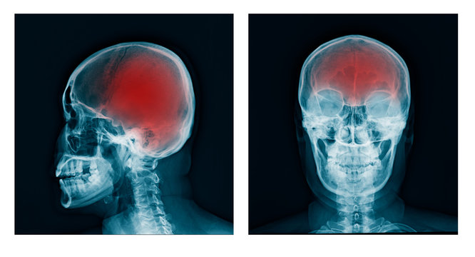 x-ray skull AP/lateral view