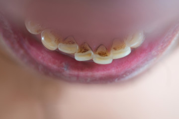 Limestone plaque in the mouth.