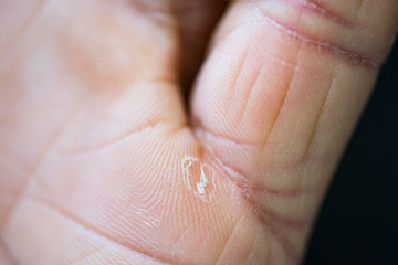 Peeling skin on the palms