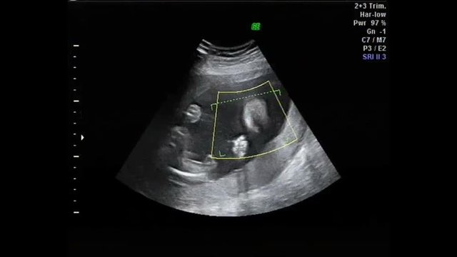 Ultrasound view of pregnancy