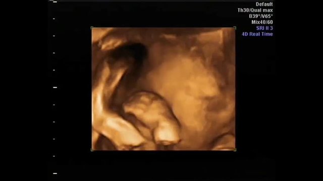 4D color ultrasound of pregnancy