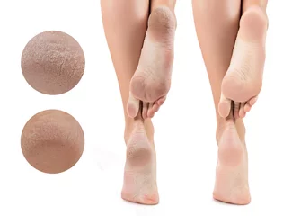 Küchenrückwand glas motiv Feet with dry skin before and after treatment. © Dmitrii Kotin