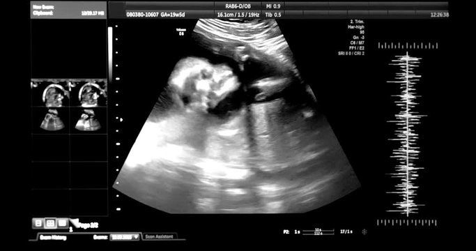 4K - Medical ultrasound scanning. baby silhouette