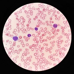Human blood smear under 100X light microscope with blast cells and hypochromic abnormal red blood cells (Selective focus).