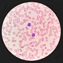 Human blood smear under 100X light microscope with blast cells and hypochromic red blood cells (Selective focus).