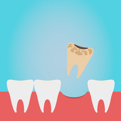 Extracted tooth in tongs. Dentist pulls out sick tooth. Stamatologic concept. Remove root. Vector illustration flat design. Isolated on background.