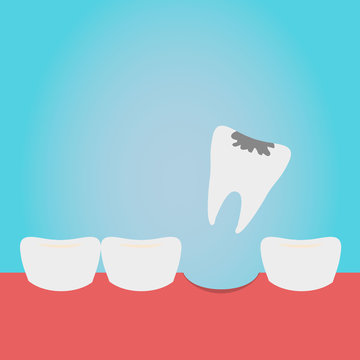 Extracted tooth in tongs. Dentist pulls out sick tooth. Stamatologic concept. Remove root. Vector illustration flat design. Isolated on background.
