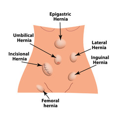Types of hernia. Epigastric, Lateral, Umbilical, Inguinal, femoral, incisional hernia. intestinal hernia. Infographics. Vector illustration on isolated background.