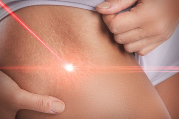 Stretch marks during laser removal session treatment