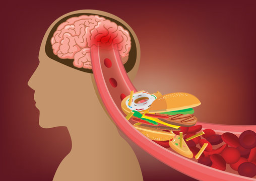 Blood Can't Flow Into Human Brain Because Fast Food Made Clogged Arteries. Illustration About Stoke Disease And Medical Concept.