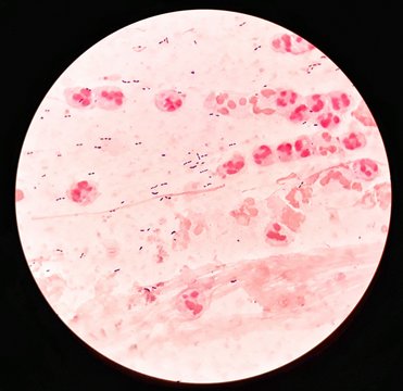 Smear of Gram's stained from sputum specimen with gram positive cocci bacteria, mucous and numerous white blood cells, under 100X light microscope .