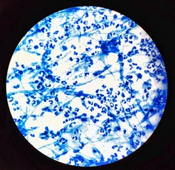 Smear of Acid-Fast bacilli (AFB) stained from sputum specimen with mucous and numerous white blood...
