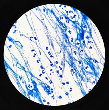 Smear of Acid-Fast bacilli (AFB) stained from sputum specimen with mucous and numerous white blood cells, under 100X light microscope .