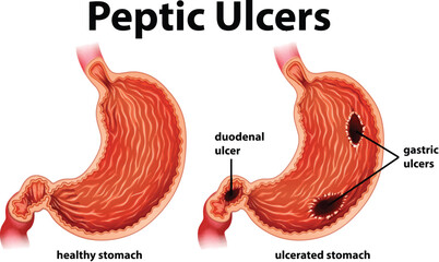 Diagram showing peptic ulcers - obrazy, fototapety, plakaty