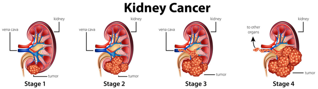 Diagram showing different stages of kidney cancer