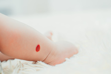 Hemangioma in a newborn baby girl on a leg