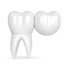 3d render of teeth with dental cantilever bridge