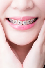 close up woman wear brace