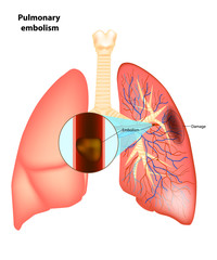 Pulmonary  embolism. Vector illustration - obrazy, fototapety, plakaty